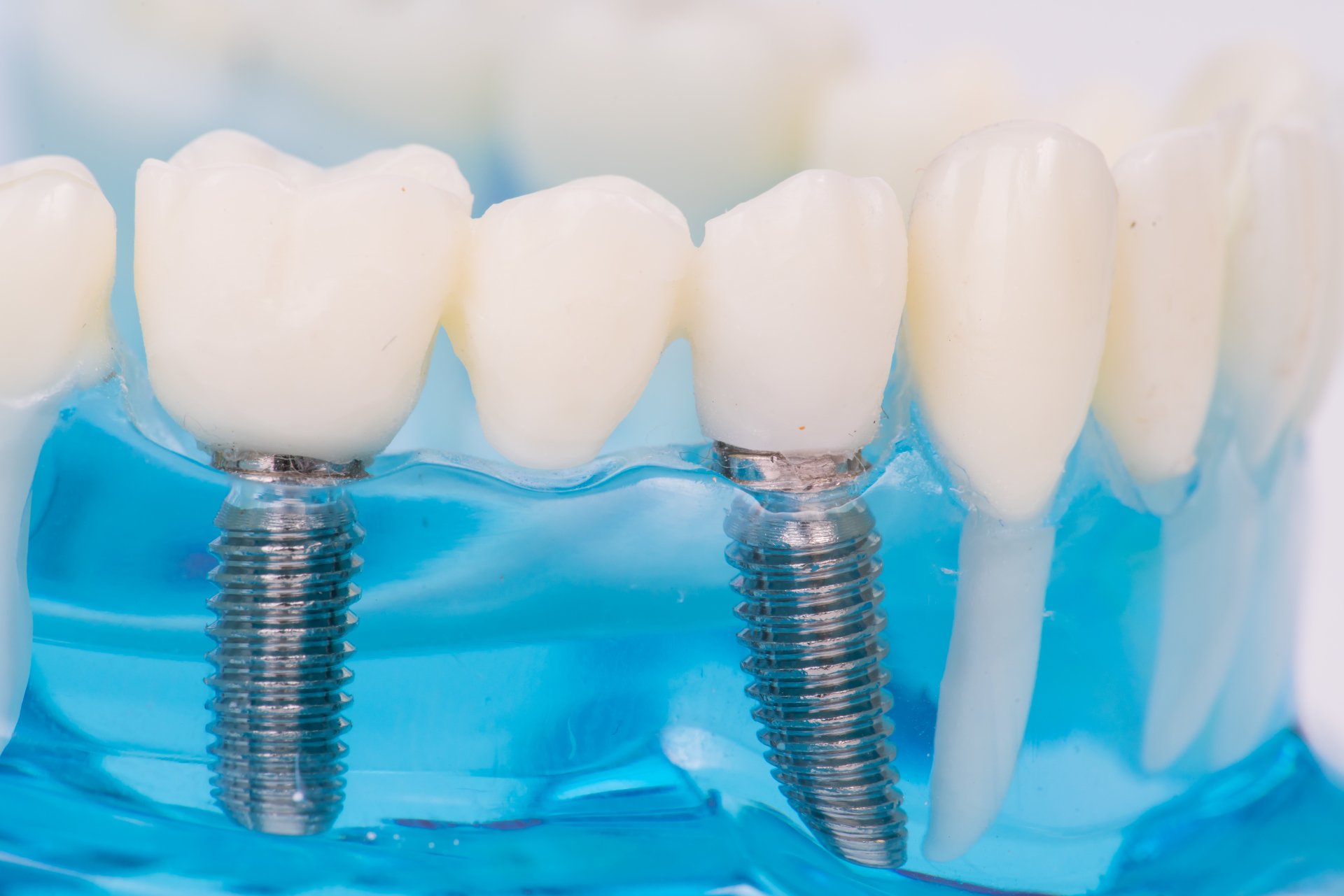 Dental Implant Procedure in San Diego, CA