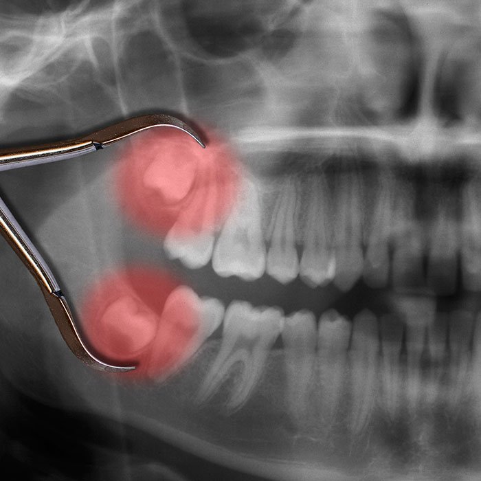 Oral Surgery Gulfport, MS Harborview Oral & Facial Surgery