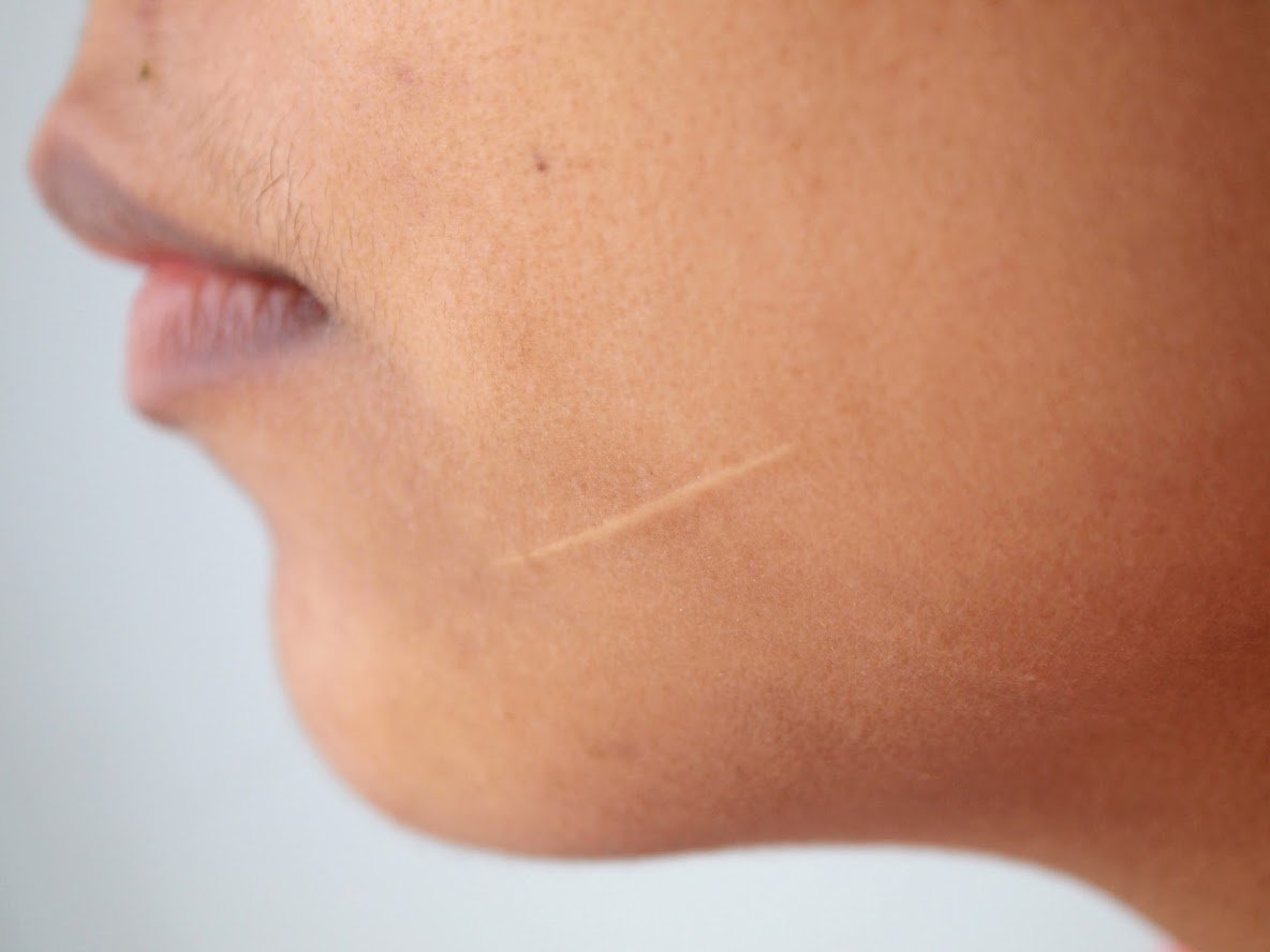 How to heal a cut on face without scarring