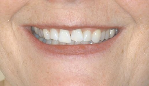 worn teeth an in