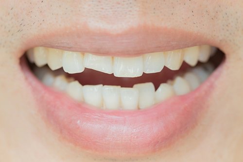 What To Do If You Chipped A Tooth