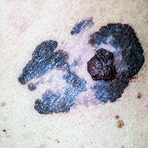 Mohs Surgery — Idaho Falls, ID — Idaho Falls Dermatology